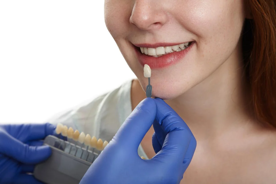 Composite Veneers